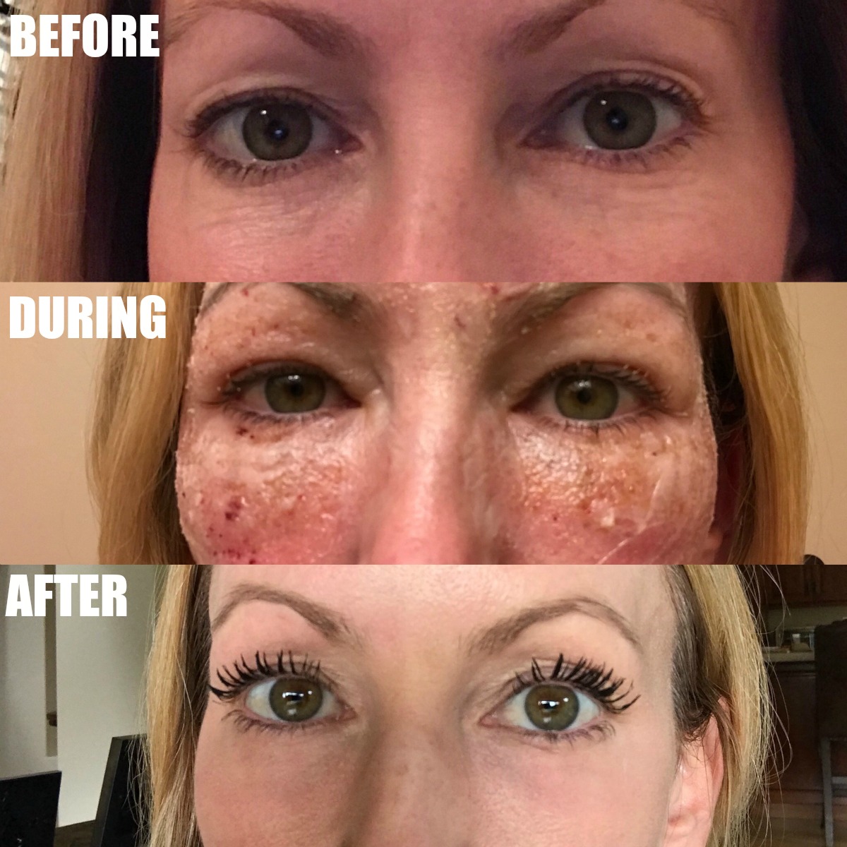 CO2 Laser Treatment on Eyes